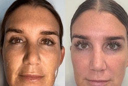 علاج قلم البلازما في أبو ظبي قبل بعد