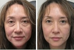 علاج قلم البلازما في أبو ظبي قبل وبعد