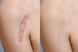 قبل وبعد إزالة الندبات المتضخمة في أبو ظبي