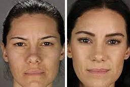 قبل وبعد جراحة رفع الحاجب في أبو ظبي