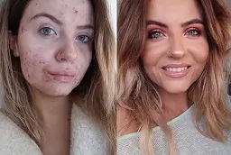 قبل وبعد علاج إزالة السمرة في أبوظبي