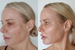 قبل وبعد علاج الوخز بالابر الدقيقة في أبو ظبي