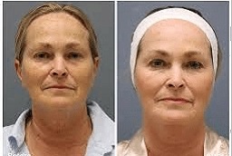 علاج ديرمابين 6 قبل وبعد علاج ديرمابين في أبوظبي