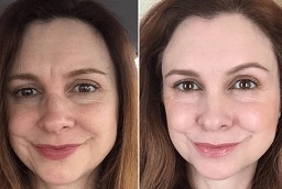 قبل وبعد علاج قلم البلازما في أبو ظبي