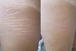 إزالة علامات التمدد في أبو ظبي قبل بعد