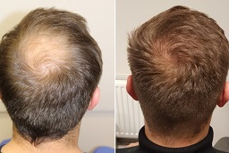 زراعة شعر التاج 8 زراعة شعر التاج في أبو ظبي قبل بعد