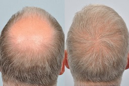 زراعة شعر التاج في أبو ظبي قبل وبعد