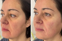 شد الجلد بالليزر في أبو ظبي قبل بعد