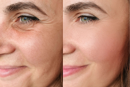 علاج حقن بروفايلو 8 علاج البروفايلو في أبو ظبي قبل بعد