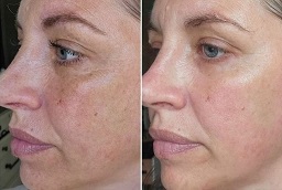 علاج البروفايلو في أبو ظبي قبل وبعد