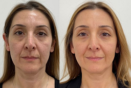 علاج التقشير PCA 8 علاج التقشير PCA في أبو ظبي قبل بعد