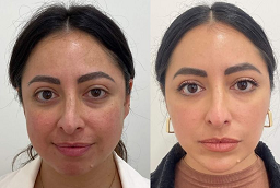 علاج التقشير PCA 7 علاج التقشير PCA في أبو ظبي قبل وبعد