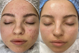 علاج التقشير الأخضر 8 علاج التقشير الأخضر في أبو ظبي قبل بعد