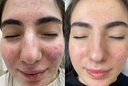 علاج التقشير الأخضر 7 علاج التقشير الأخضر في أبو ظبي قبل وبعد