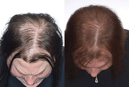 علاج تساقط الشعر بالليزر 9 علاج الشعر بالليزر لتساقط الشعر في أبو ظبي قبل بعد