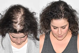 علاج الشعر بالليزر لتساقط الشعر في أبو ظبي قبل وبعد