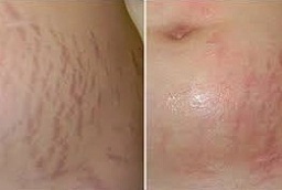 قبل وبعد إزالة علامات التمدد في أبو ظبي