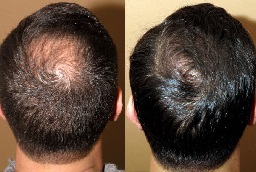 قبل وبعد زراعة شعر التاج في أبو ظبي