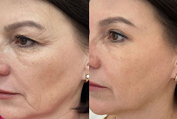 قبل وبعد علاج البروفايلو في أبو ظبي