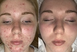 علاج التقشير الأخضر 6 قبل وبعد علاج التقشير الأخضر في أبو ظبي