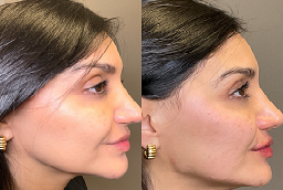 نحت خط الفك 8 نحت خط الفك في أبو ظبي قبل بعد