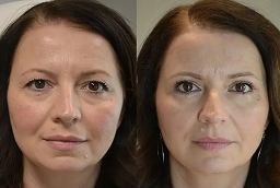 هيدرافيشل أبوظبي 8 هيدرافيشل أبوظبي قبل بعد