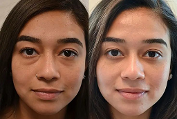 هيدرافيشل أبوظبي 7 هيدرافيشل أبوظبي قبل وبعد