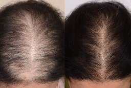 علاج الشعر بالبلازما الغنية بالصفائح الدموية 8 أفضل علاج للشعر بالبلازما الغنية بالصفائح الدموية في أبوظبي قبل بعد