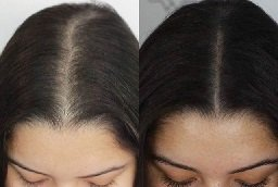 أفضل علاج للشعر بالبلازما الغنية بالصفائح الدموية في أبوظبي قبل وبعد