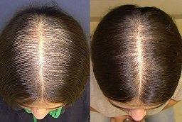 قبل وبعد أفضل علاج للشعر بالبلازما الغنية بالصفائح الدموية في أبوظبي