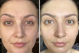 العلاج بالضوء LED 8 العلاج بالضوء LED في أبو ظبي قبل بعد