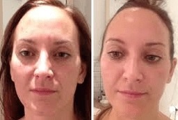 العلاج بالضوء LED 7 العلاج بالضوء LED في أبو ظبي قبل وبعد