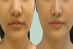 جراحة تصغير الشفاه في أبو ظبي قبل بعد