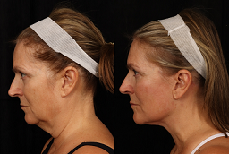 عملية شد الرقبة 8 شد الرقبة في أبوظبي قبل بعد