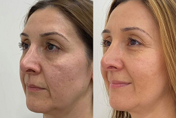 علاج البيكو ليزر 8 علاج البيكو ليزر في أبو ظبي قبل بعد