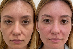 علاج ديرمابين مايكرو نيدلينج 8 علاج ديرمابين مايكرو نيدلينج في أبو ظبي قبل بعد