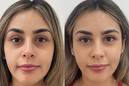 علاج ديرمابين مايكرو نيدلينج 7 علاج ديرمابين مايكرو نيدلينج في أبو ظبي قبل وبعد