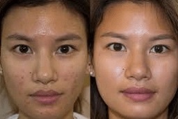 العلاج بالضوء LED 6 قبل وبعد العلاج بالضوء LED في أبو ظبي