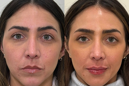 علاج ديرمابين مايكرو نيدلينج 6 قبل وبعد علاج ديرمابين مايكرو نيدلينج في أبو ظبي