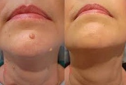 إزالة الزوائد الجلدية 8 إزالة الزوائد الجلدية في أبو ظبي قبل بعد