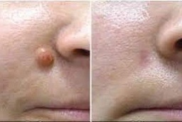 إزالة الزوائد الجلدية في أبو ظبي قبل وبعد