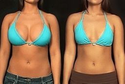 تصغير الثدي 8 تصغير الثدي في أبوظبي قبل بعد