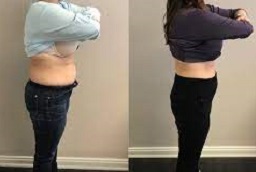 حقن إنقاص الوزن في أبو ظبي قبل وبعد