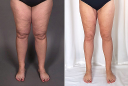 شد الجزء السفلي من الجسم 8 شد الجزء السفلي من الجسم في أبو ظبي قبل بعد