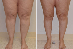 شد الجزء السفلي من الجسم في أبو ظبي قبل وبعد