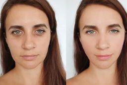 علاج شد الوجه بالخيوط 8 شد الخيوط في أبو ظبي قبل بعد