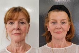 علاج شد الوجه بالخيوط 7 شد الخيوط في أبو ظبي قبل وبعد