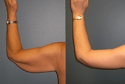 شد الذراعين 8 شد الذراعين في أبو ظبي قبل بعد