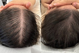 علاج GFC للشعر 8 علاج GFC للشعر في أبو ظبي قبل بعد