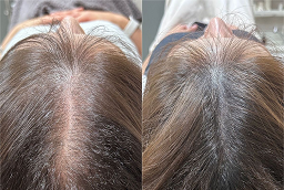 علاج GFC للشعر في أبو ظبي قبل وبعد